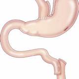 Treatment Of Hyperinsulinemic Hypoglycemia After Gastric Bypass Pictures