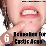 Best Home Treatment For Cystic Acne Pictures