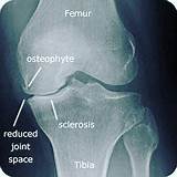 Osteophytes In Knee Joint Treatment Photos