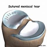 Pictures of Meniscus Tear Rehabilitation Protocol
