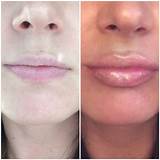 Best Lip Augmentation Doctor Pictures