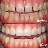 Images of Dental Bonding Before And After Pics