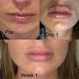 Images of Best Lip Augmentation Doctor In Houston