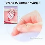 Pictures of Hpv Wart Removal Home Remedies