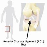 Posterior Cruciate Ligament Tear Treatment