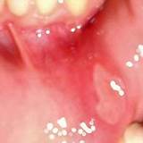 Can Cold Sores Be In Your Mouth Images