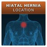 Pictures of Hiatal Hernia Repair Recovery Time