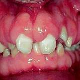 Pictures of Sore On My Gums Treatment