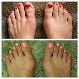 Foot Surgery For Bunions Recovery
