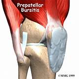 Exercises Knee Bursitis Images