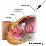 Laparoscopic Kidney Surgery Recovery Time Pictures