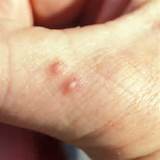 Images of Fire Ants Bite Remedy