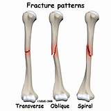Images of Broken Humerus Bone Recovery Time