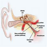 Eustachian Tube Relief Photos