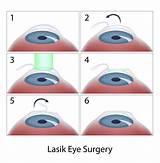 Photos of Second Lasik Eye Surgery