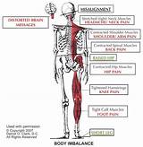 Chiropractic Treatment For Pinched Nerve In Neck Images