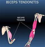 Images of Bicep Tendonitis Recovery Time
