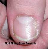 Nail Pitting Treatment Images