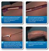 Photos of Chronic Venous Insufficiency Endovenous Laser Treatment