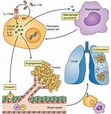 Current Treatment For Pancreatic Cancer Pictures