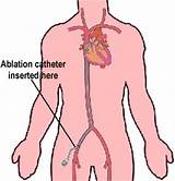 Heart Ablation Procedure Recovery Pictures
