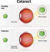 Cataract And Glaucoma Surgery Recovery Time Pictures