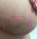 Images of Which Doctor To See For Breast Lump