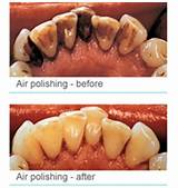 Photos of Tooth Abrasion Treatment Cost