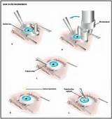 Detroit Lasik Eye Surgery Pictures