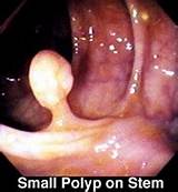 Cancerous Polyps In Colon Treatment Pictures