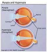 Photos of Does Lasik Affect Near Vision