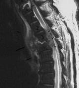 Spinal Cord Abscess Treatment Photos