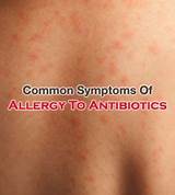 Allergy Medicine Side Effects Symptoms Photos