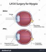 Pictures of Lasik Eye Surgery Photos