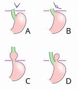 What Type Of Doctor Should I See For A Hernia Photos