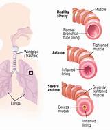Images of Common Treatments For Asthma