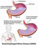 Gastroesophageal Junction Cancer Treatment Photos