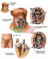 Images of Spinal Stenosis Neck Surgery Recovery Time