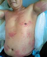 Photos of Shiitake Dermatitis Treatment
