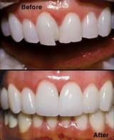 Teeth Bonding Insurance Photos