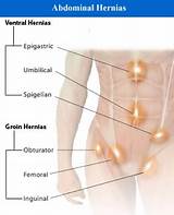 Pictures of What Is A Hernia Doctor Called