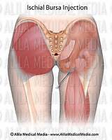 Ischial Tuberosity Pain Syndrome Treatment Images