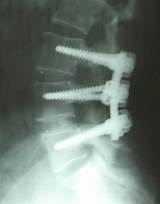 Hospital Stay After Spinal Fusion Pictures