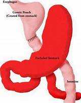 Photos of Can A Gastric Bypass Be Revised