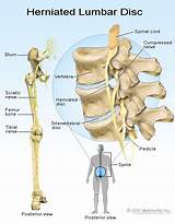 Chiropractic Treatment For Herniated Disc In Lower Back