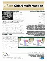 Pictures of Chiari Malformation Headache Treatment