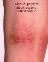 Eczema On Back Of Knees Treatment Photos
