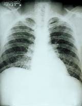Calcium In Lungs Treatment Pictures