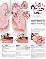 Life Insurance With Copd Pictures