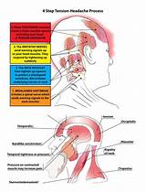 Best Treatment For Chronic Tension Headaches Images